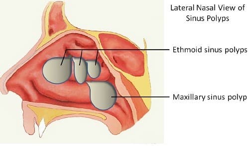 Polyp mũi có thể gặp ở mọi lứa tuổi, hiếm khi có ở trẻ em dưới 10 tuổi, thường xuất hiện ở độ tuổi sau 30