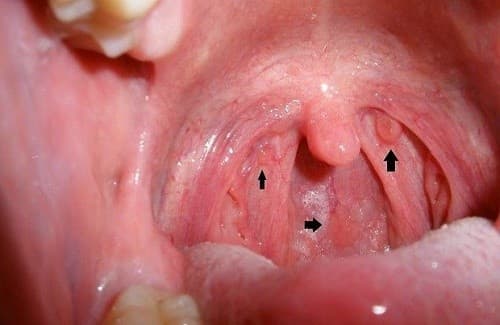 Nguyên nhân gây viêm họng hạt vùng hầu họng và amidan