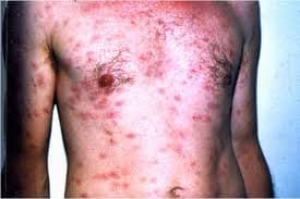 nhung-benh-xa-hoi-thuong-gap8