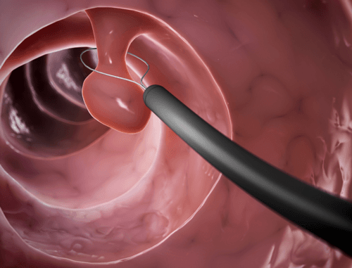 Polyp cổ tử cung là những u nhỏ, có thể xuất phát từ cổ tử cung ngoài hay từ cổ tử cung trong, thò ra lỗ ngoài cổ tử cung.