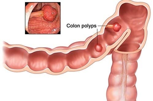 Polyp dạ dày là bệnh lành tính nhưng cũng có nhiều trường hợp tiến triển thành ác tính, nguy hiểm tới tính mạng