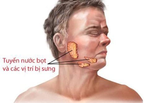 Viêm tuyến nước bọt thường không lây lan thành dịch như bệnh quai bị