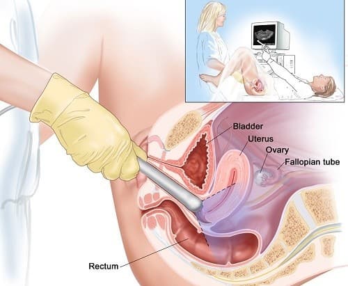 Siêu âm đầu dò để làm gì? Để giúp đánh giá tử cung, buồng trứng và các thành phần trong tiểu khung với độ chính xác cao.