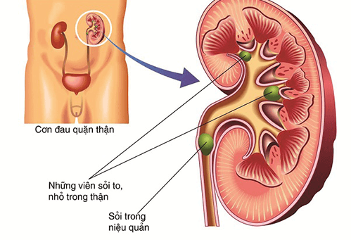 Sỏi niệu quản điều trị như thế nào?