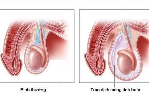 Tràn dịch màng tinh hoàn ở người lớn do nhiều nguyên nhân gây ra như nhiễm trùng, mắc các bệnh lý về tinh hoàn...