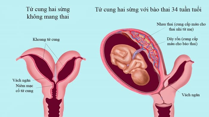 Hình ảnh cấu trúc tử cung khi mang thai ở người có tử cung hai sừng
