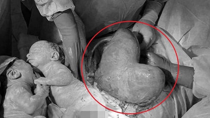 Trường hợp hiếm gặp bà mẹ có tử cung hai sừng sinh đôi