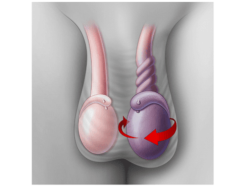 Xoắn tinh hoàn là bệnh lý do tinh hoàn tự xoay quanh trục gây tắc nghẽn đột ngột thừng tinh, làm giảm hoặc tắc lượng máu đến tinh hoàn