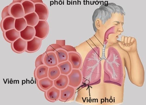 Viêm phổi là hiện tượng nhiễm khuẩn ở vùng nhu môi phổi, viêm ở các túi phế nang, ống phế nang