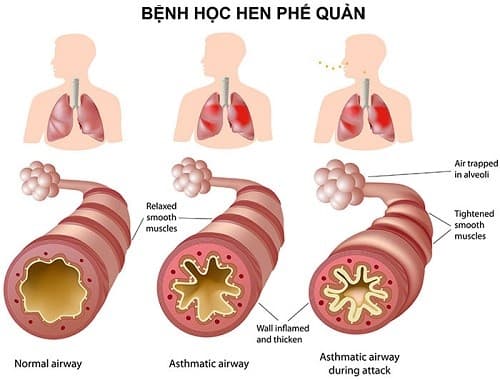 Hen phế quản là bệnh thường gặp do nhiều nguyên nhân khác nhau gây ra như thay đổi thời tiết, dị ứng phấn hoa, lông vật nuôi...