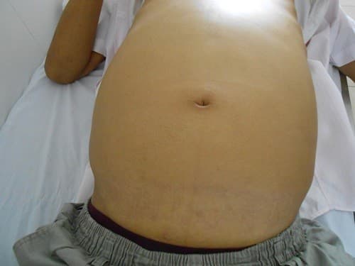 Cổ trướng hoặc tích tụ dịch ở bụng là một trong những triệu chứng xơ gan giai đoạn cuối