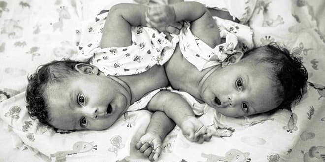 cap-song-sinh-gai-truoc-va-sau-khi-mo-tach