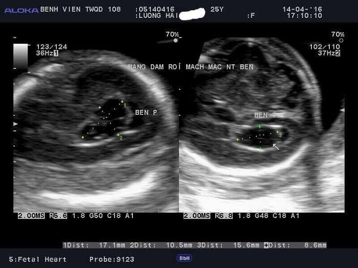 Nang đám rối mạch mạc được phát hiện trong quá trình siêu âm