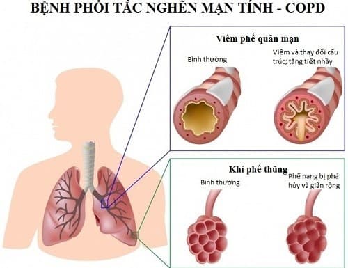 Việc nhận biết phổi tắc nghẽn mạn tính sớm có ý nghĩa quyết định đến việc điều trị và chất lượng cuộc sống của người bệnh