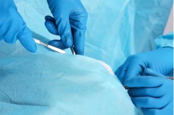 phau-thuat-thoat-vi-ben-jpg1