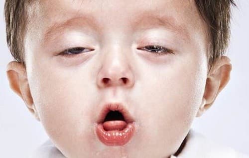 trẻ bị viêm phế quản là bệnh lý về đường hô hấp rất hay gặp ở trẻ em do sức đề kháng yếu.