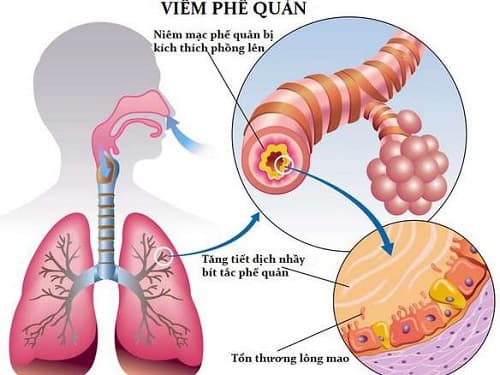 Viêm phế quản cấp ở người cao tuổi là tình trạng phế quản bị viêm đột ngột, kèm theo sự phản ứng tại chỗ và toàn cơ thể.