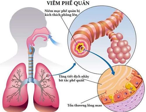 Viêm phế quản cấp là bệnh lý về đường hô hấp do nhiều nguyên nhân gây ra