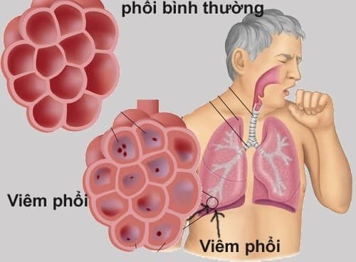 Viêm phổi cấp tính là bệnh lý về đường hô hấp do nhiều nguyên nhân gây ra như vi khuẩn, virus...