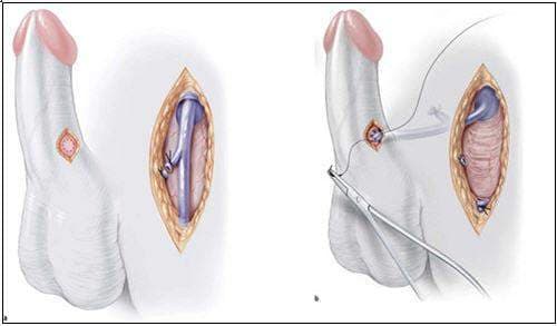 Vỡ vật hang là gi một trong những tổn thương gây rối loạn cương dương rất nghiêm trọng.