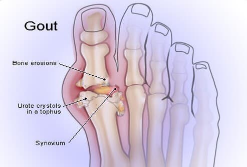 Bệnh gout là gì là điều nhiều người băn khoăn thắc mắc