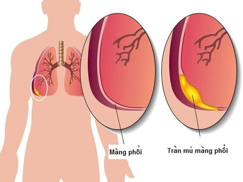 Bệnh viêm mủ màng phổi có thể gây biến chứng nguy hiểm nên người bệnh cần điều trị sớm ngay từ khi mới phát hiện bệnh