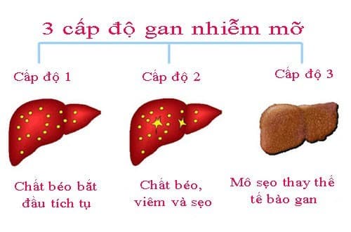 3 cấp độ của gan nhiễm mỡ