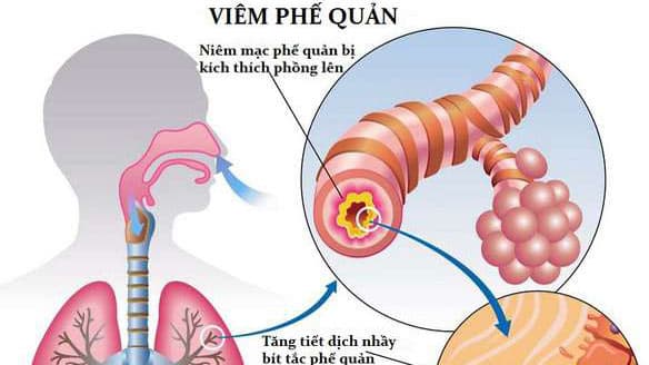 dieu-tri-hieu-qua-viem-phe-quan-cap-tinh-1