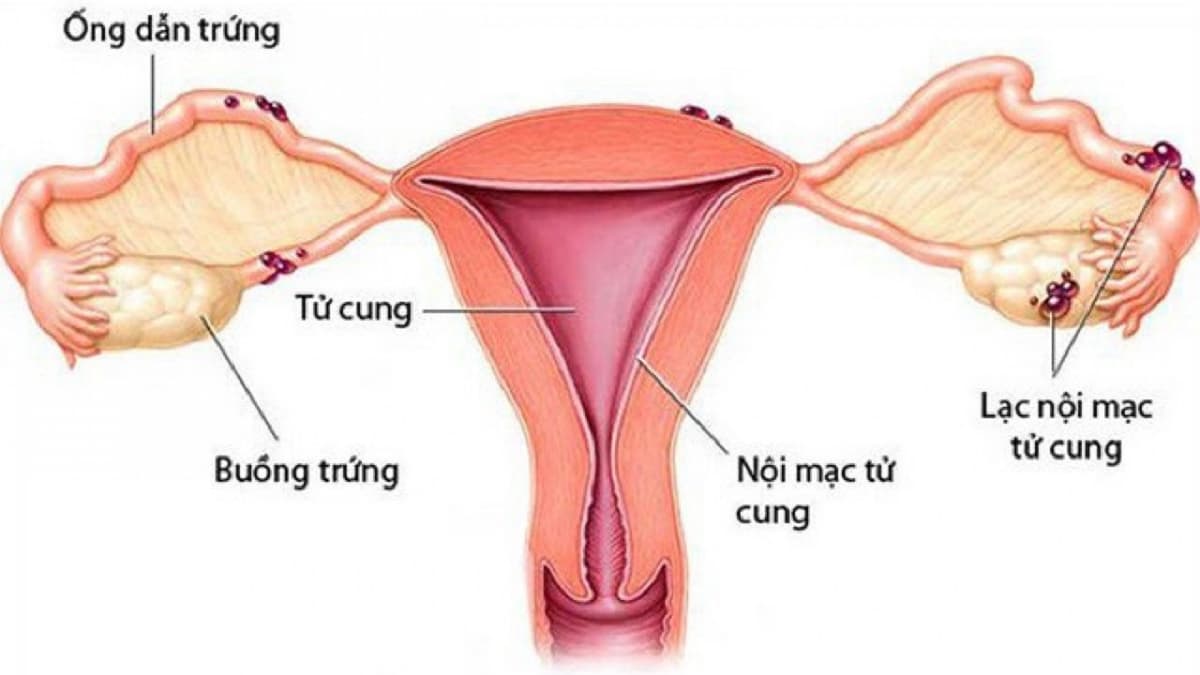 Phẫu thuật nội soi lạc nội mạc tử cung