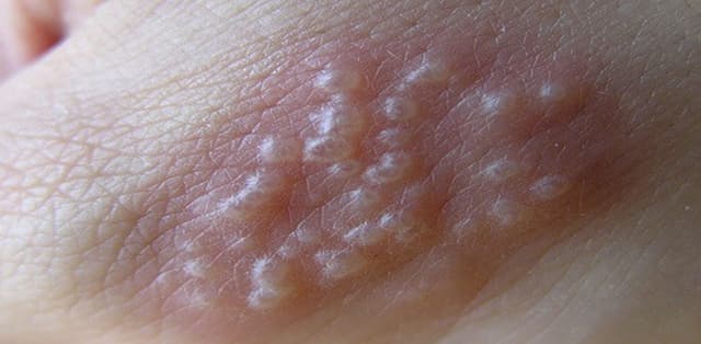 Những điều cần biết về mụn rộp sinh dục có lây nhiễm nhanh không