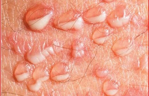 Có nhiều cách điều trị để hạn chế các đợt bùng phát của bệnh nhưng không thể làm hết hẳn virus, vì virus sẽ ở lại trong cơ thể người bệnh suốt đời.