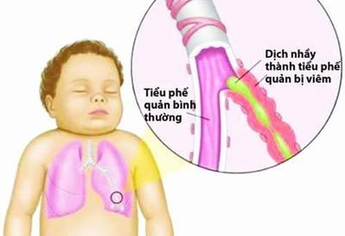 Bệnh viêm tiểu phế quản hay xảy ra ở trẻ dưới 24 tháng tuổi, thường gặp nhất là 3 - 6 tháng tuổi.