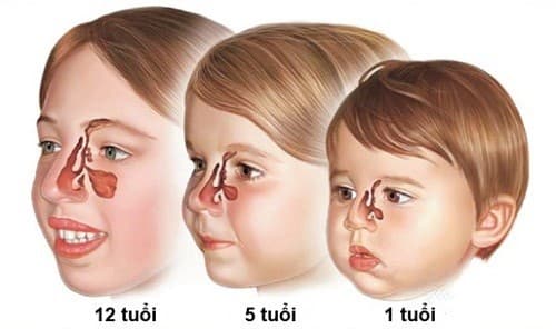 Trẻ em dễ mắc bệnh viêm xoang khi thời tiết chuyển lạnh, ảnh hưởng tới sức khỏe