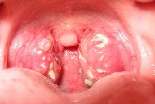 Triệu chứng điển hình của viêm VA là sưng đỏ