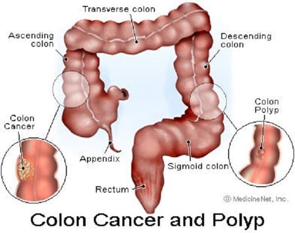 Polyp trực tràng cần phát hiện sớm và điều trị hiệu quả