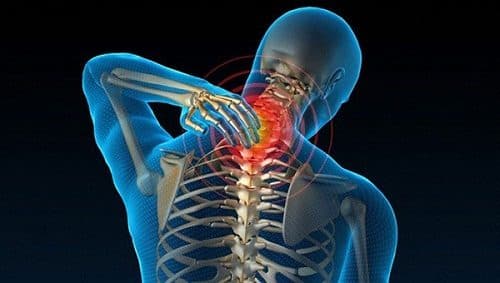 Thoái hóa đốt sống cổ là một trong những nguyên nhân gây viêm cơ vai gáy