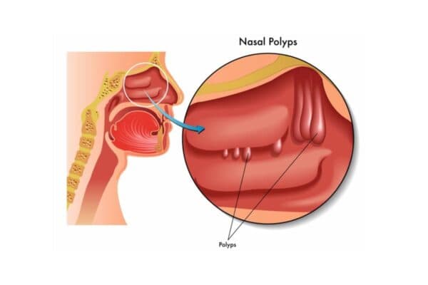 Polyp mũi khu trú ở hốc mũi hoặc xoang 