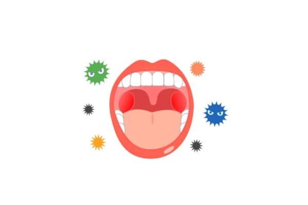 Viêm amidan là bệnh tai mũi họng thường gặp do nhiều tác nhân có hại gây ra