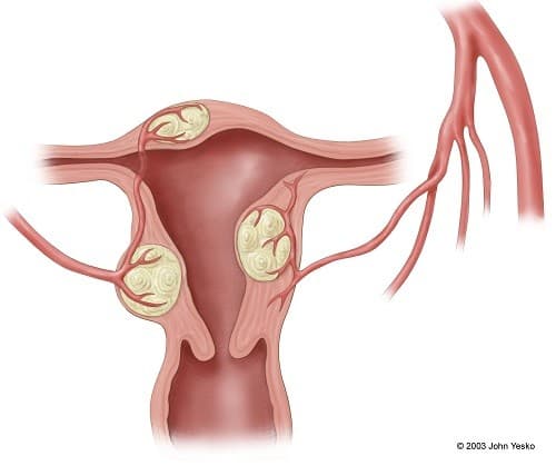 Nguyên nhân gây u xơ tử cung vẫn chưa được xác định, tuy nhiên có thể liên quan tới hormone.