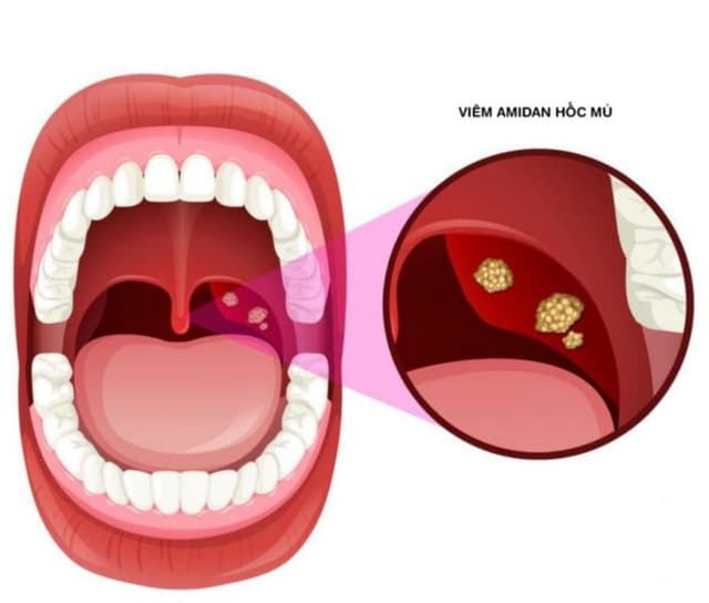 Điều trị viêm amidan hốc mủ