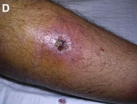 Viêm cơ nhiễm khuẩn gây sưng đỏ và có mủ tại vùng cơ bệnh