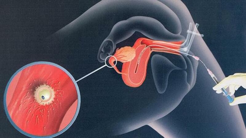  IUI là phương pháp thụ tinh nhân tạo giúp tăng cơ hội mang thai cho các cặp đôi hiếm muộn