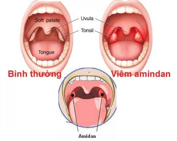 Viêm amidan cần được phát hiện sớm và điều trị đúng cách