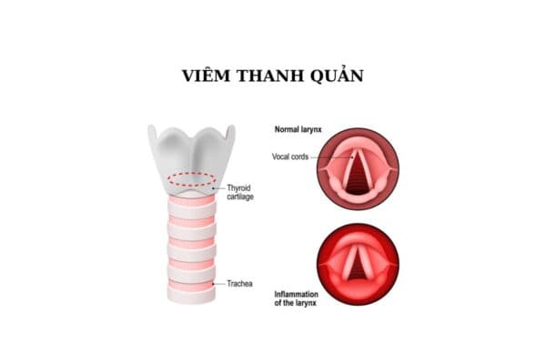 Viêm thanh quản có thể gây ra nhiều biến chứng nguy hại cho sức khỏe hệ hô hấp của người bệnh