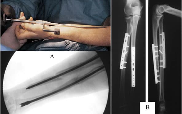 Kết hợp xương bằng nẹp vít là phương pháp hiệu quả