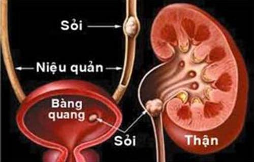 Sỏi niệu quản cần được phát hiện sớm và điều trị hiệu quả