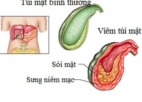 Sỏi mật có thể gây viêm nguy hiểm