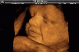 Siêu âm 4d cho hình ảnh sắc nét