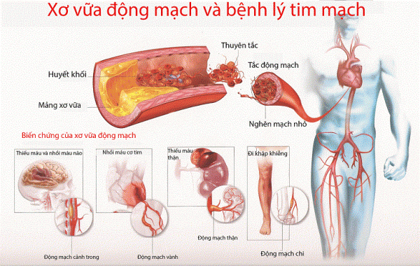 Khi có dấu hiệu bệnh tim mạch cần siêu âm mạch máu