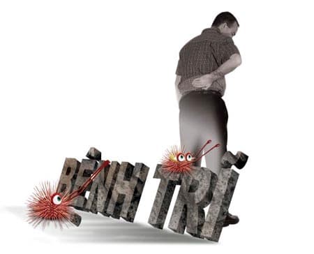 Bệnh trĩ có thể tự phát hiện bằng những dấu hiệu lâm sàng